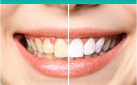 Before and after teeth whitening comparison